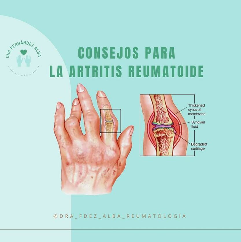 Consejos prevención artritis reumatoide