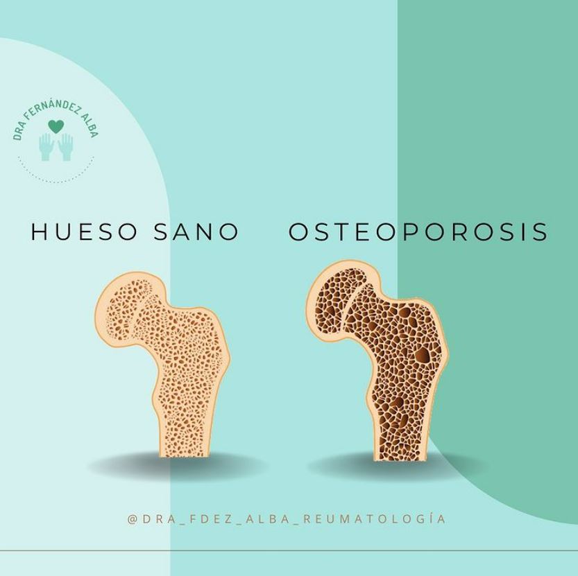 Osteoporosis síntomas diagnóstico tratamiento
