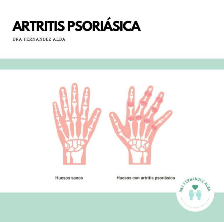 Artritis Psoriásica Reumátologo Sevilla Dra Fernández Alba