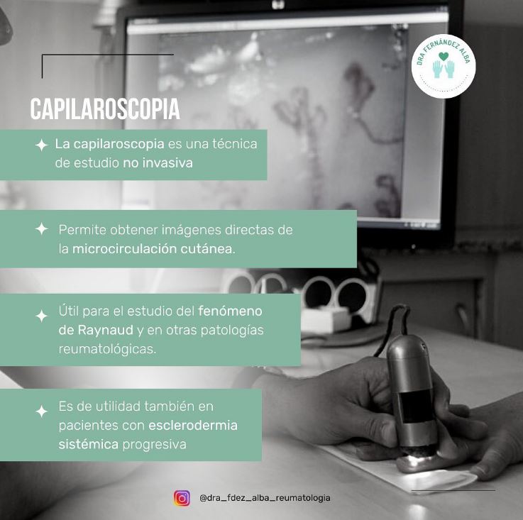 CAPILAROSCOPIA- Técnica de estudio reumatológico