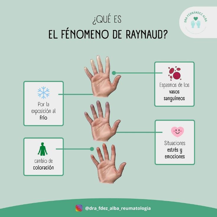 ¿Qué es el fenómeno Raynaud?